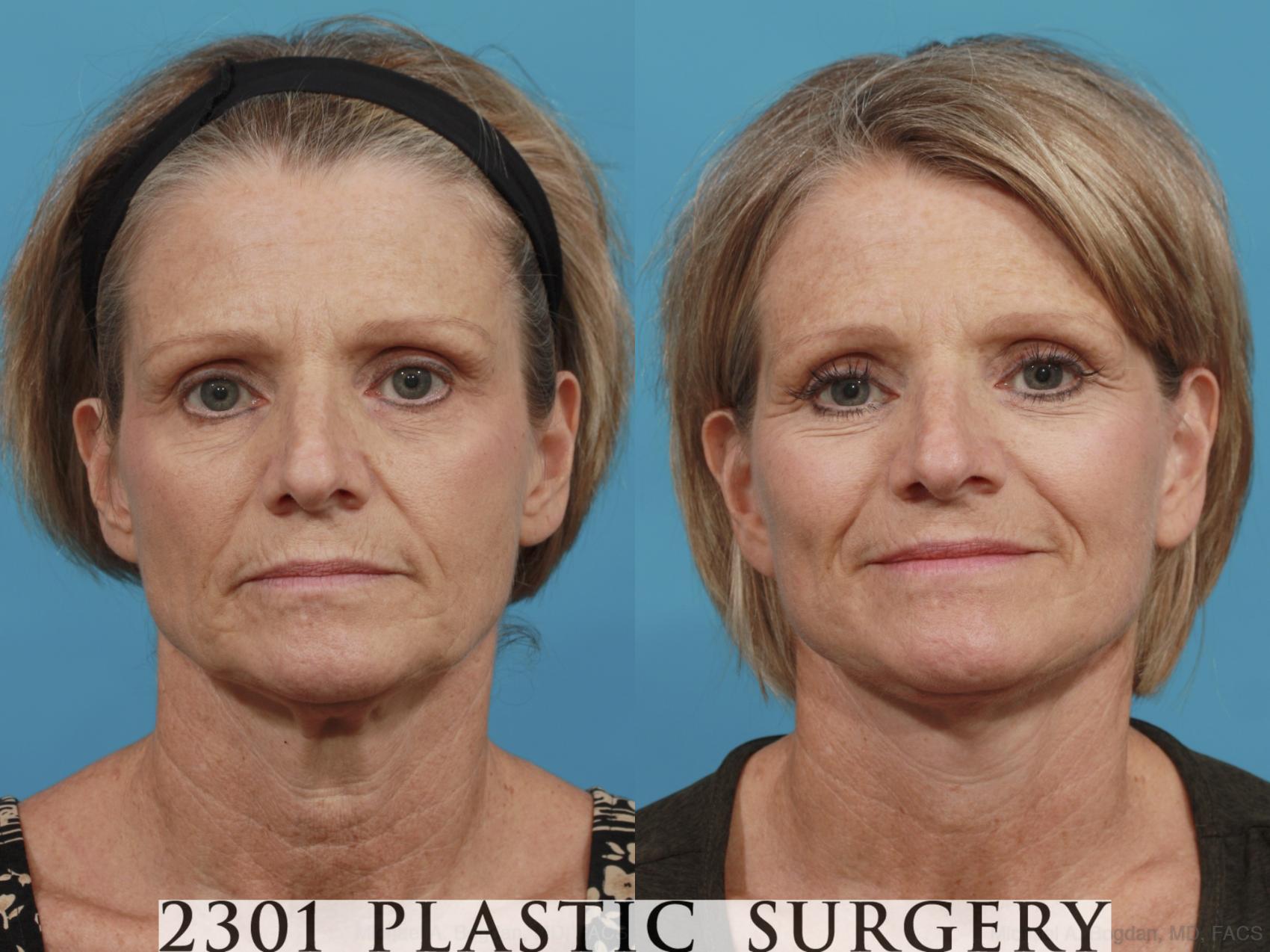 Before & After Face Lift Case 584 View #1 View in Fort Worth, Plano, & Frisco, Texas