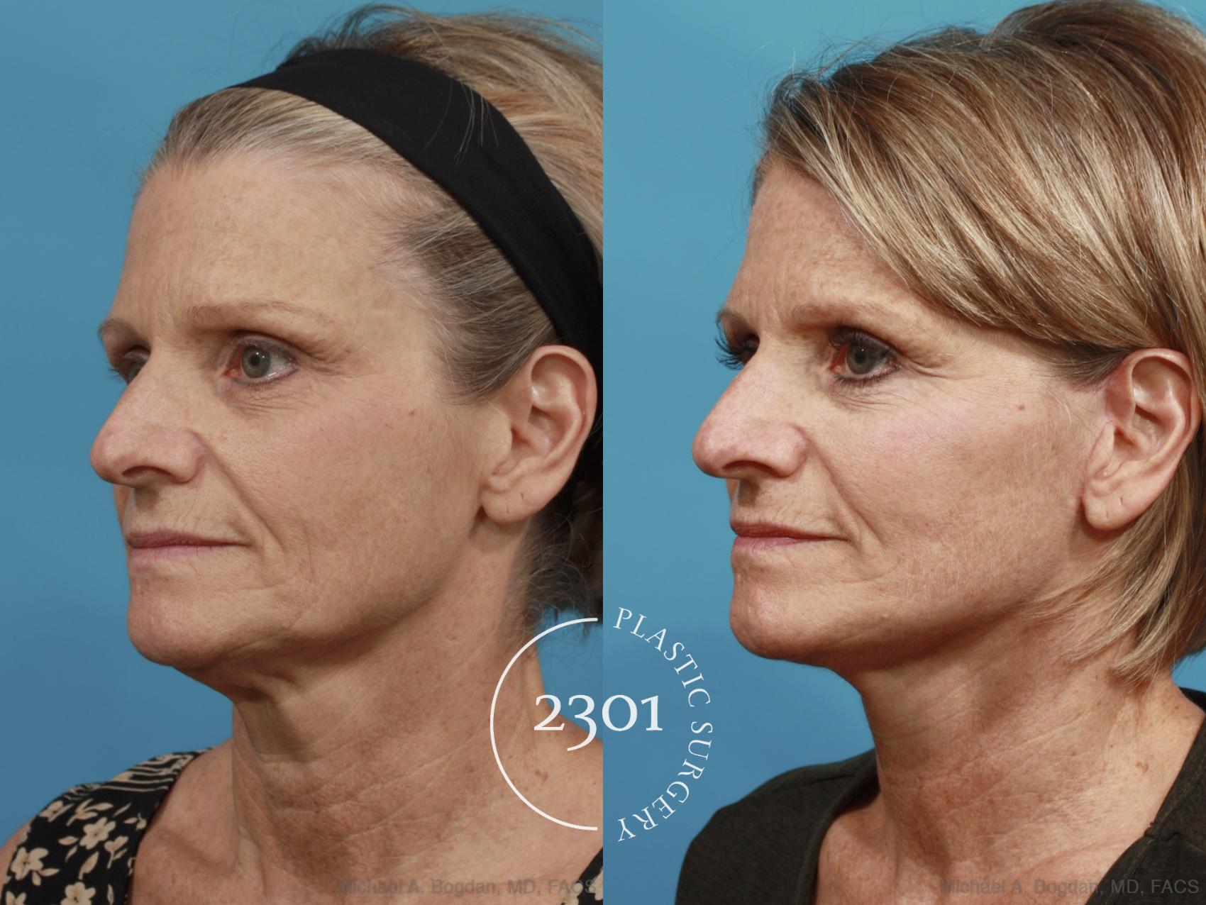 Before & After Face Lift Case 584 View #2 View in Fort Worth, Plano, & Frisco, Texas