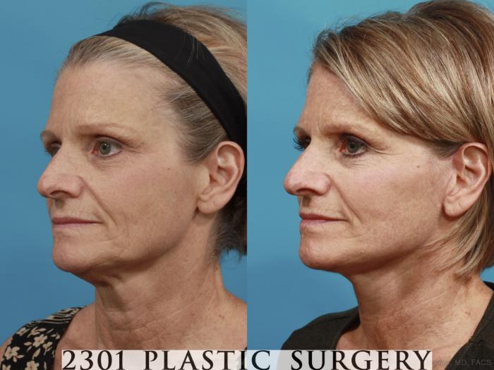 Before & After Face Lift Case 584 View #2 View in Fort Worth, Plano, & Frisco, Texas