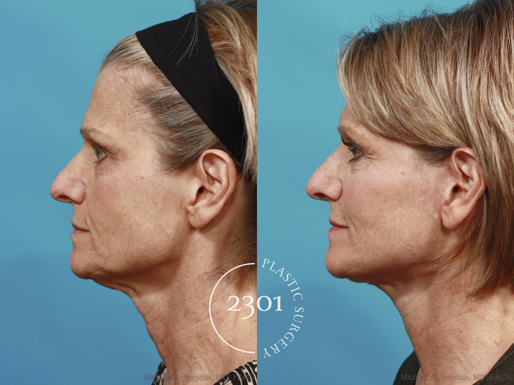 Before & After Face Lift Case 584 View #3 View in Fort Worth, Plano, & Frisco, Texas
