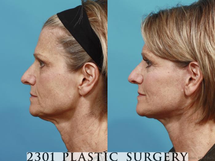 Before & After Face Lift Case 584 View #3 View in Fort Worth, Plano, & Frisco, Texas