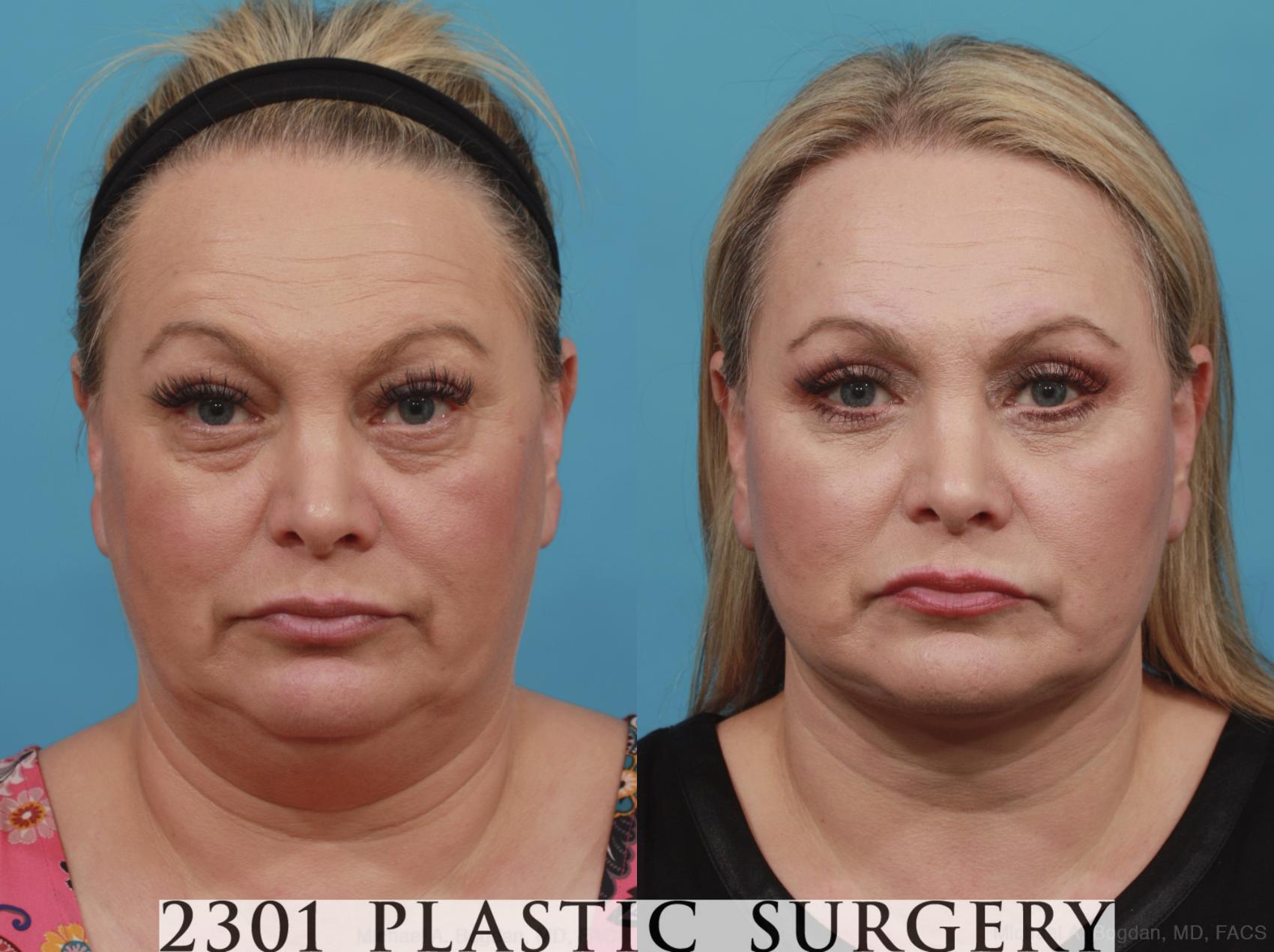 Before & After Face Lift Case 586 View #1 View in Fort Worth & Frisco, Texas