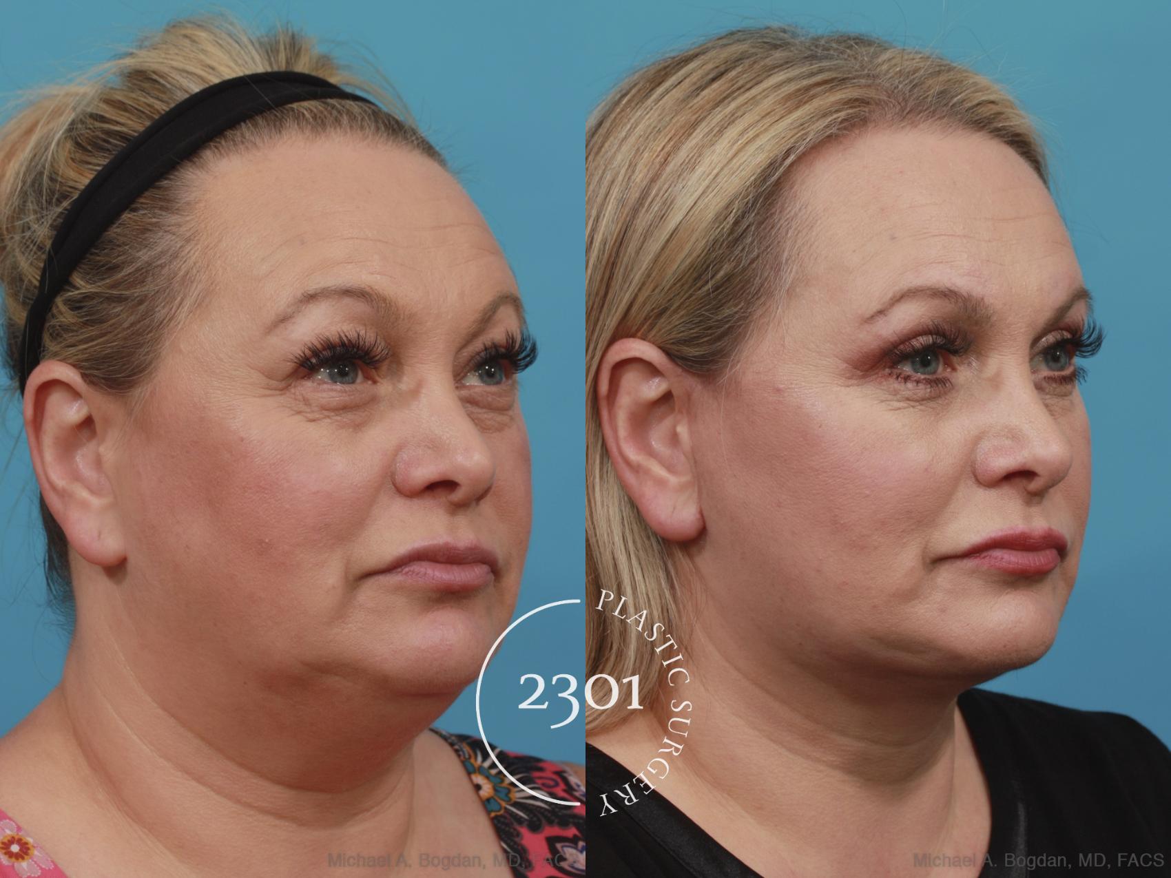 Before & After Face Lift Case 586 View #2 View in Fort Worth, Plano, & Frisco, Texas