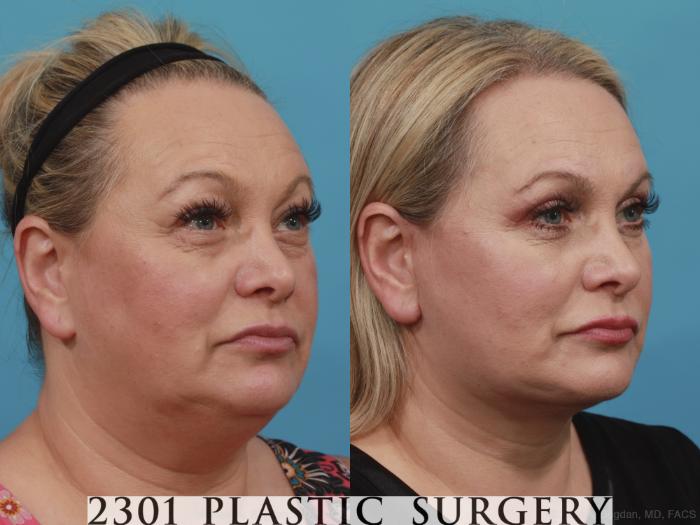Before & After Neck Lift Case 586 View #2 View in Fort Worth, Plano, & Frisco, Texas