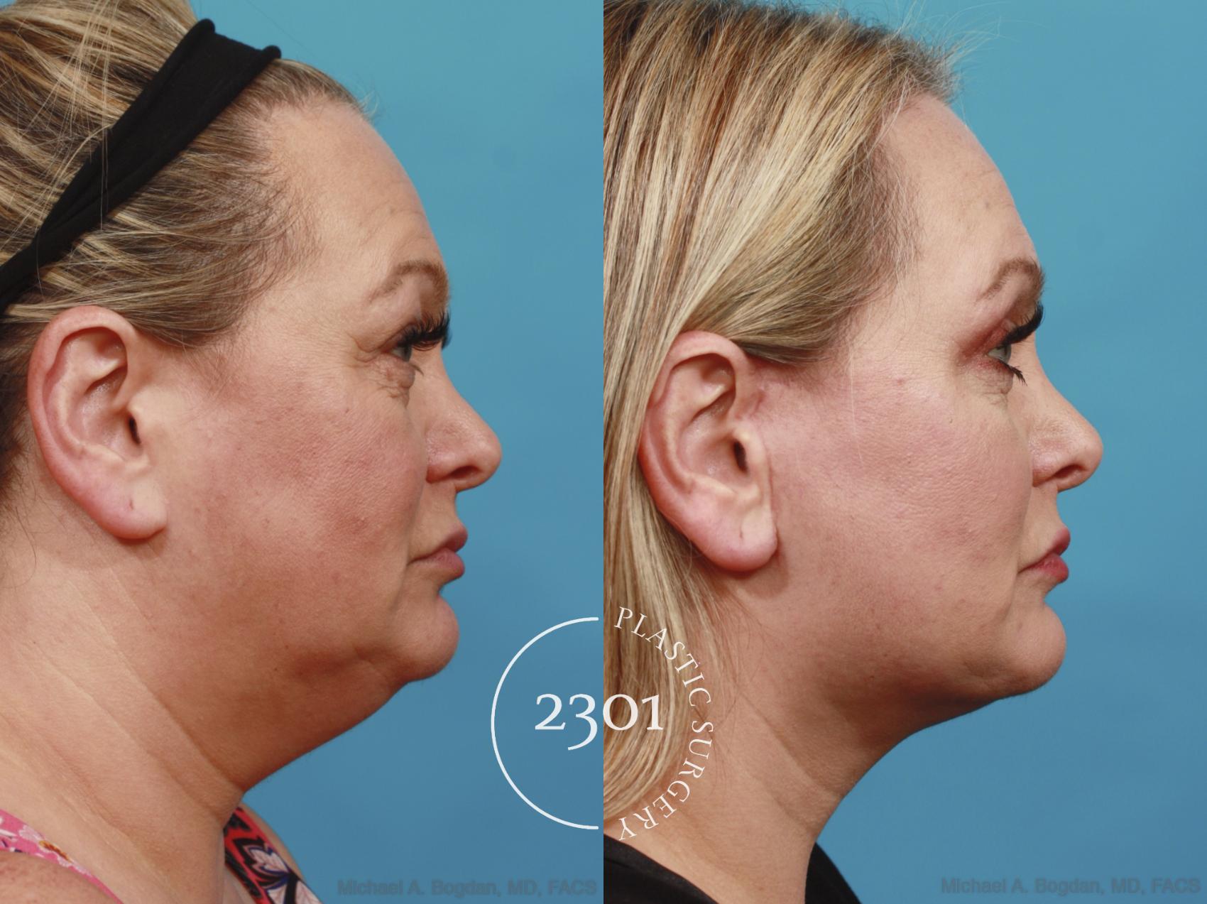 Before & After Face Lift Case 586 View #3 View in Fort Worth, Plano, & Frisco, Texas