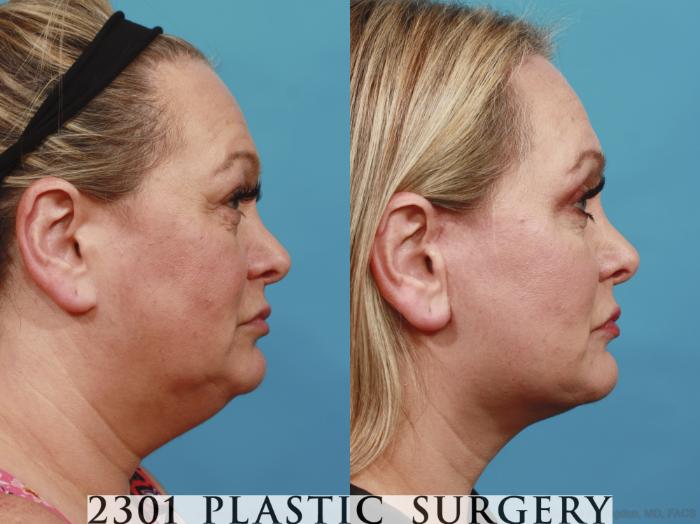 Before & After Neck Lift Case 586 View #3 View in Fort Worth, Plano, & Frisco, Texas