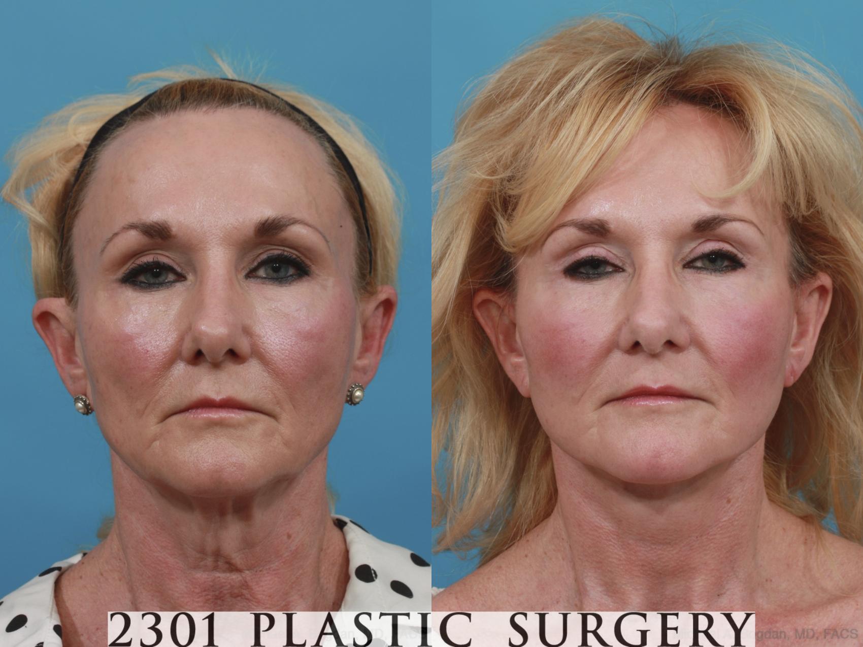 Before & After Neck Lift Case 588 View #1 View in Fort Worth & Frisco, Texas