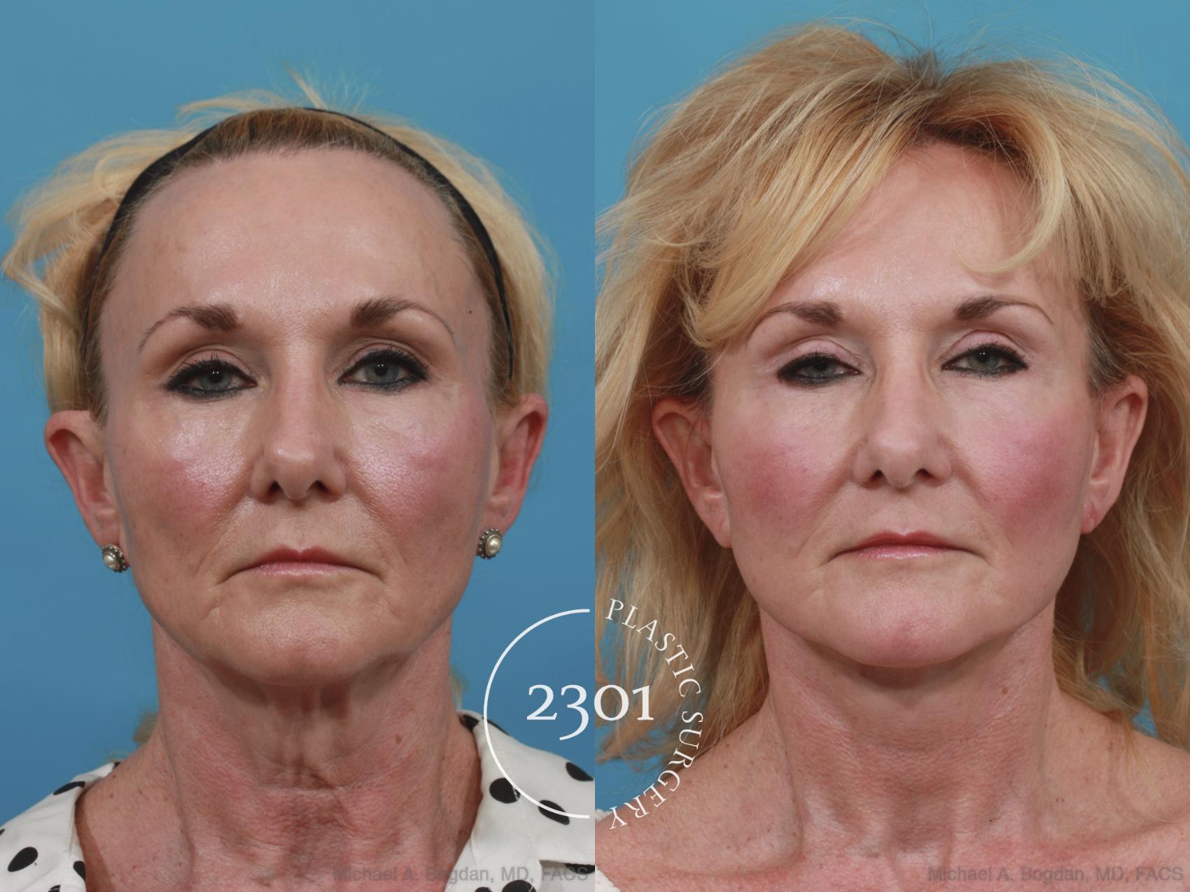 Before & After Blepharoplasty Case 588 View #1 View in Fort Worth, Plano, & Frisco, Texas