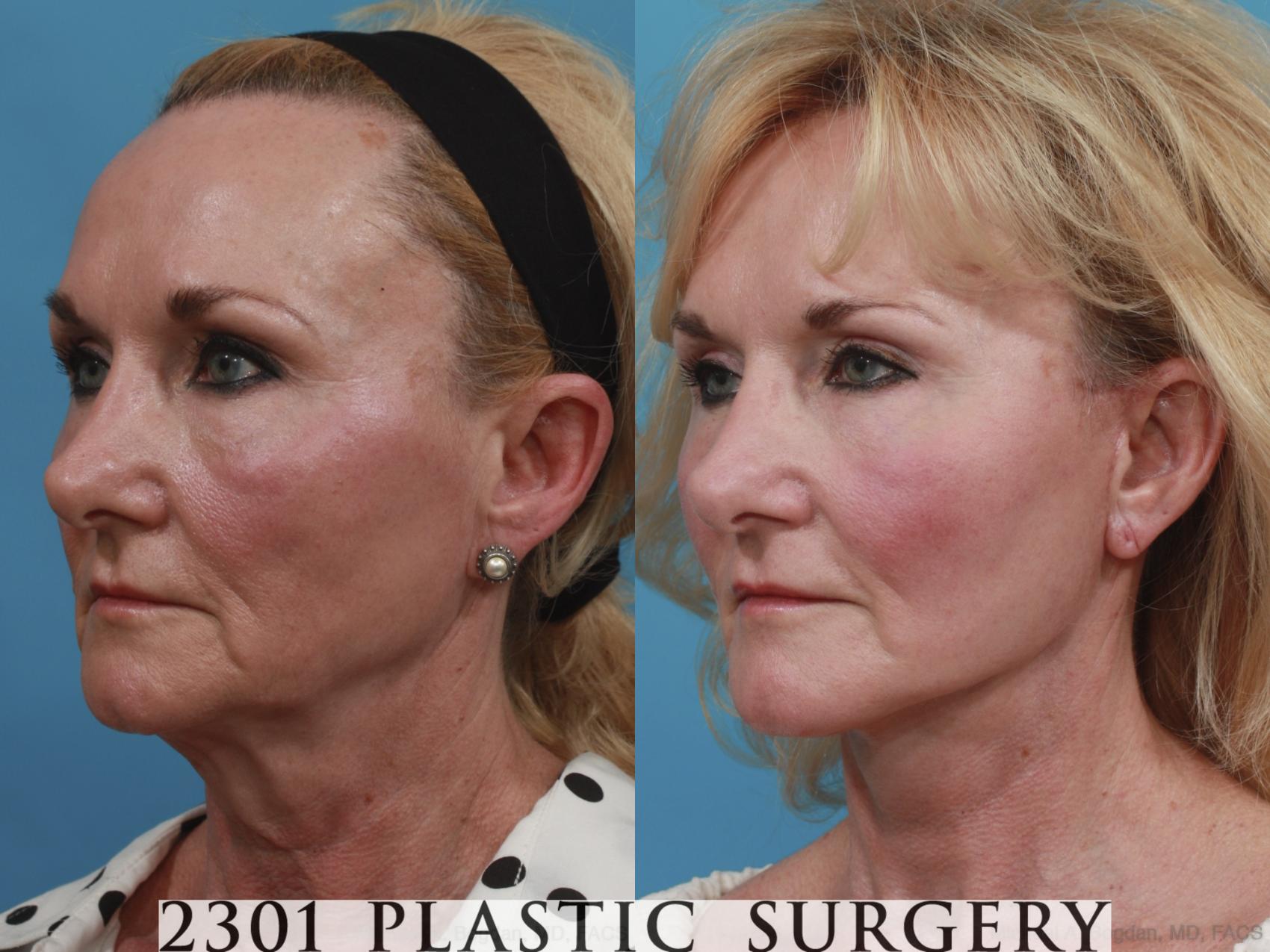 Before & After Neck Lift Case 588 View #2 View in Fort Worth & Frisco, Texas
