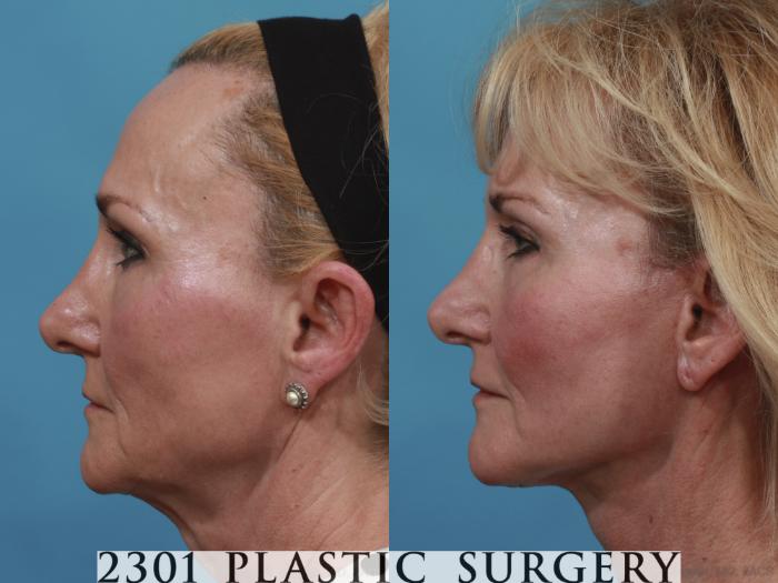 Before & After Neck Lift Case 588 View #3 View in Fort Worth, Plano, & Frisco, Texas