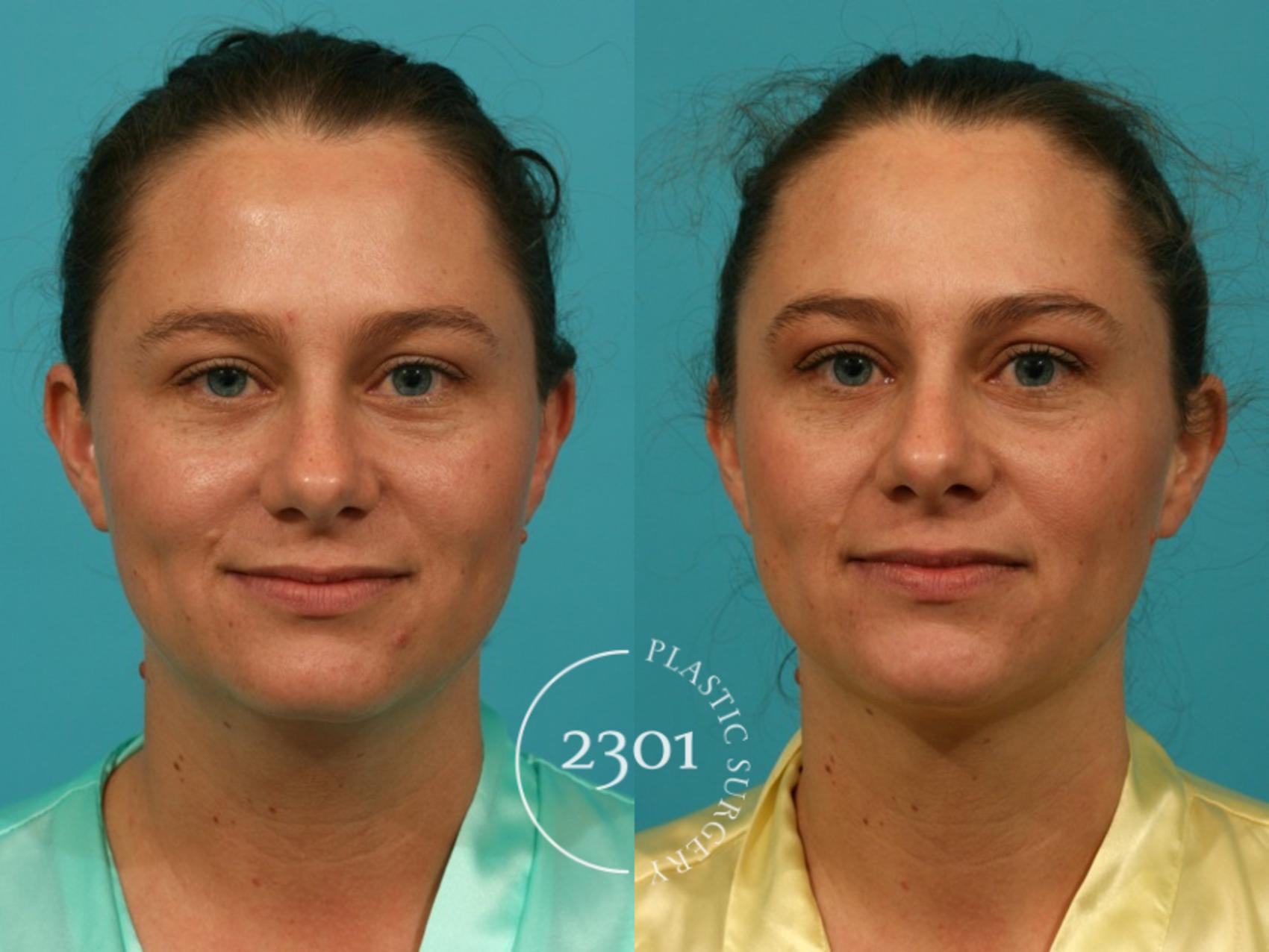 Before & After Neck Liposuction Case 66 View #1 View in Fort Worth, Plano, & Frisco, Texas