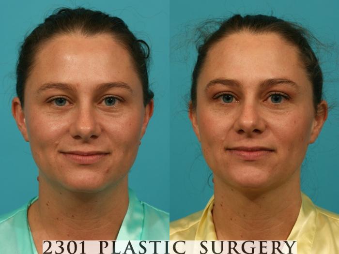 Before & After Neck Liposuction Case 66 View #1 View in Fort Worth, Plano, & Frisco, Texas