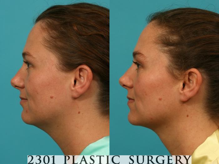 Before & After Neck Liposuction Case 66 View #2 View in Fort Worth, Plano, & Frisco, Texas