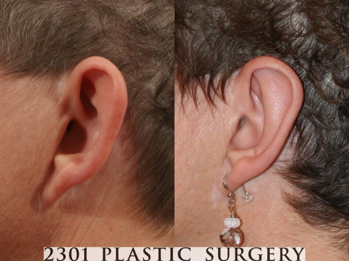 Before & After Otoplasty Case 47 View #1 View in Fort Worth & Frisco, Texas