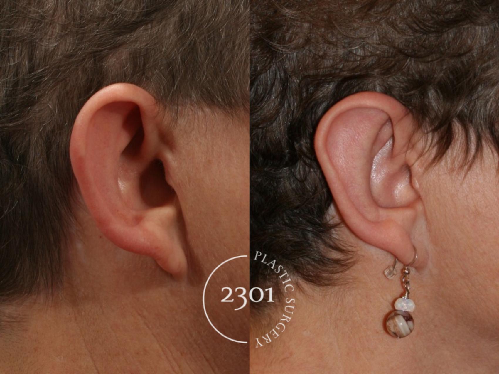 Before & After Otoplasty Case 47 View #2 View in Fort Worth, Plano, & Frisco, Texas