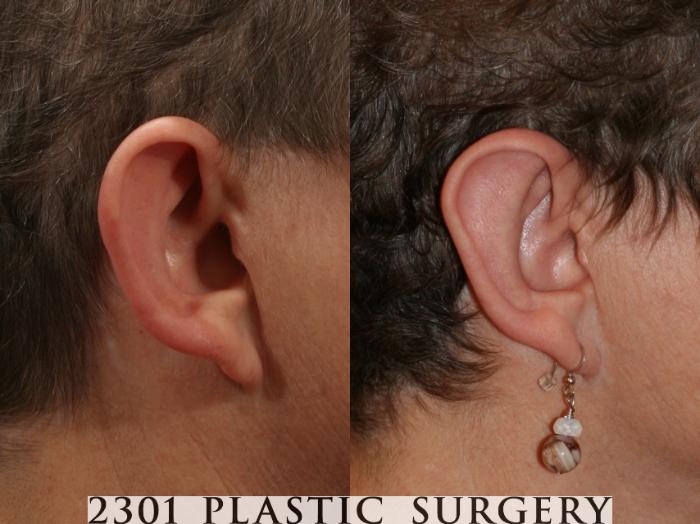 Before & After Otoplasty Case 47 View #2 View in Fort Worth & Frisco, Texas