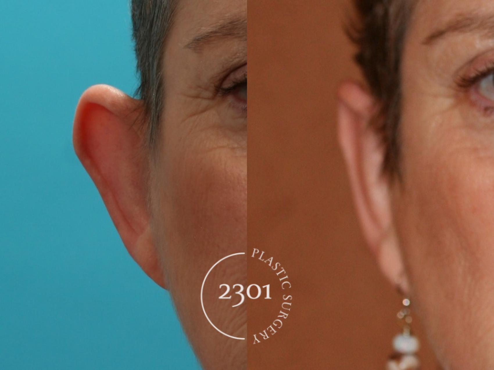 Before & After Otoplasty Case 47 View #3 View in Fort Worth, Plano, & Frisco, Texas