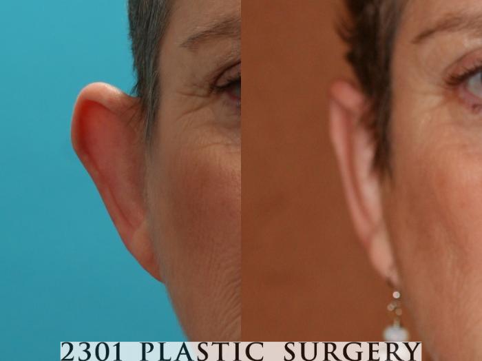 Before & After Otoplasty Case 47 View #3 View in Fort Worth & Frisco, Texas