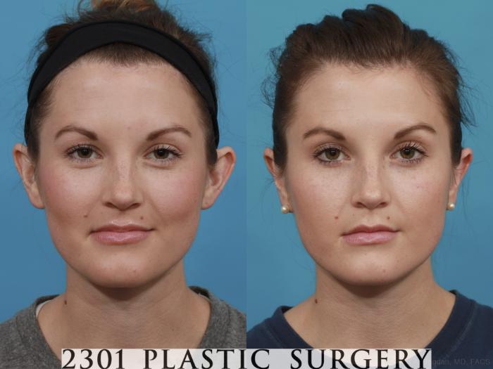 Before & After Otoplasty Case 546 View #1 View in Fort Worth & Frisco, Texas
