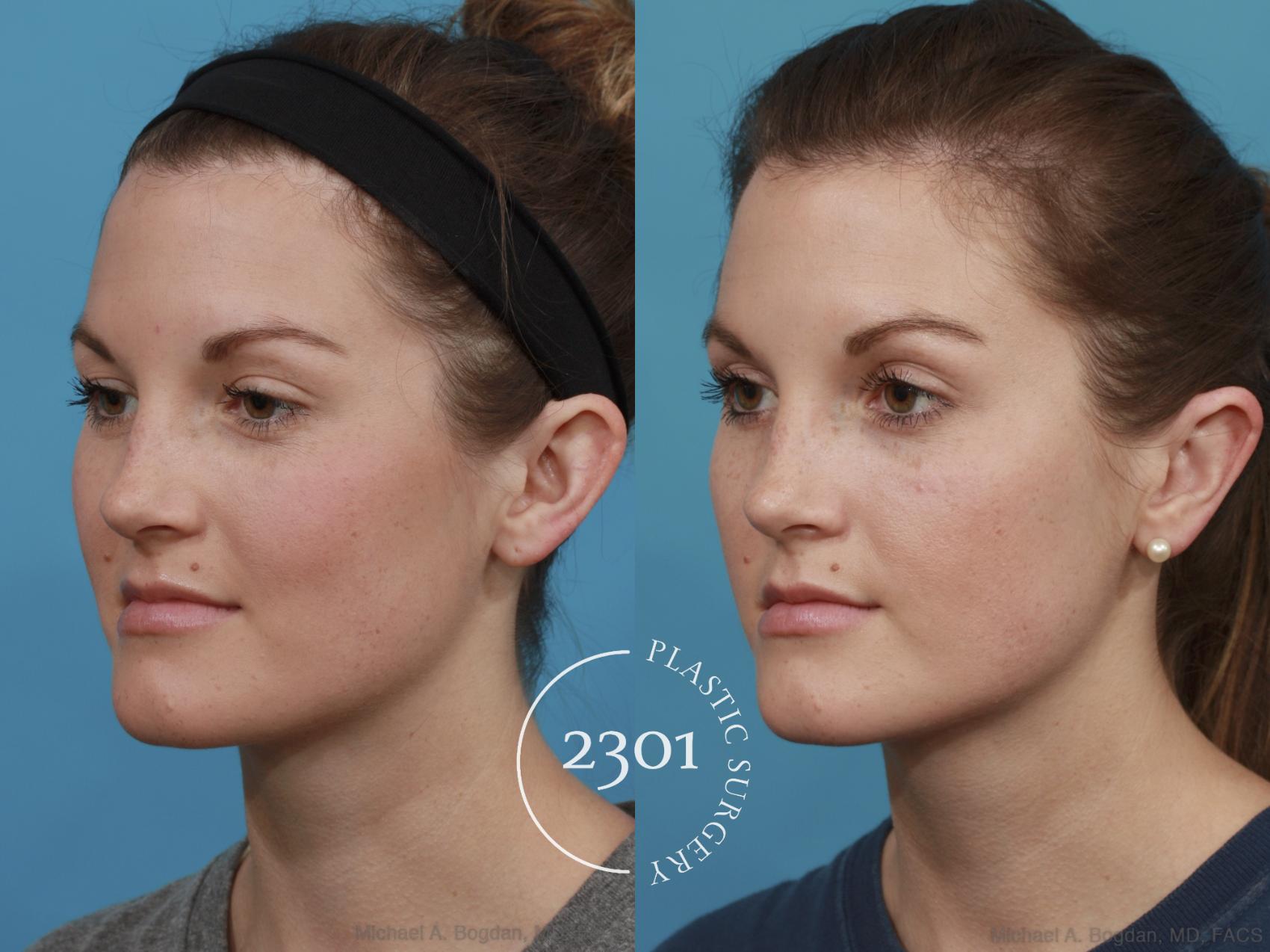 Before & After Otoplasty Case 546 View #2 View in Fort Worth, Plano, & Frisco, Texas