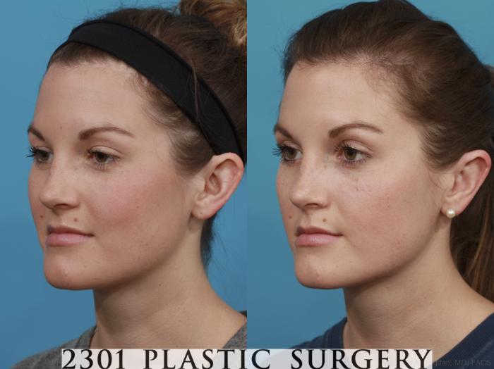 Before & After Otoplasty Case 546 View #2 View in Fort Worth & Frisco, Texas