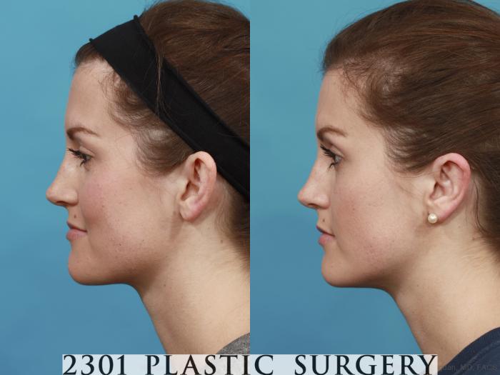 Before & After Otoplasty Case 546 View #3 View in Fort Worth & Frisco, Texas