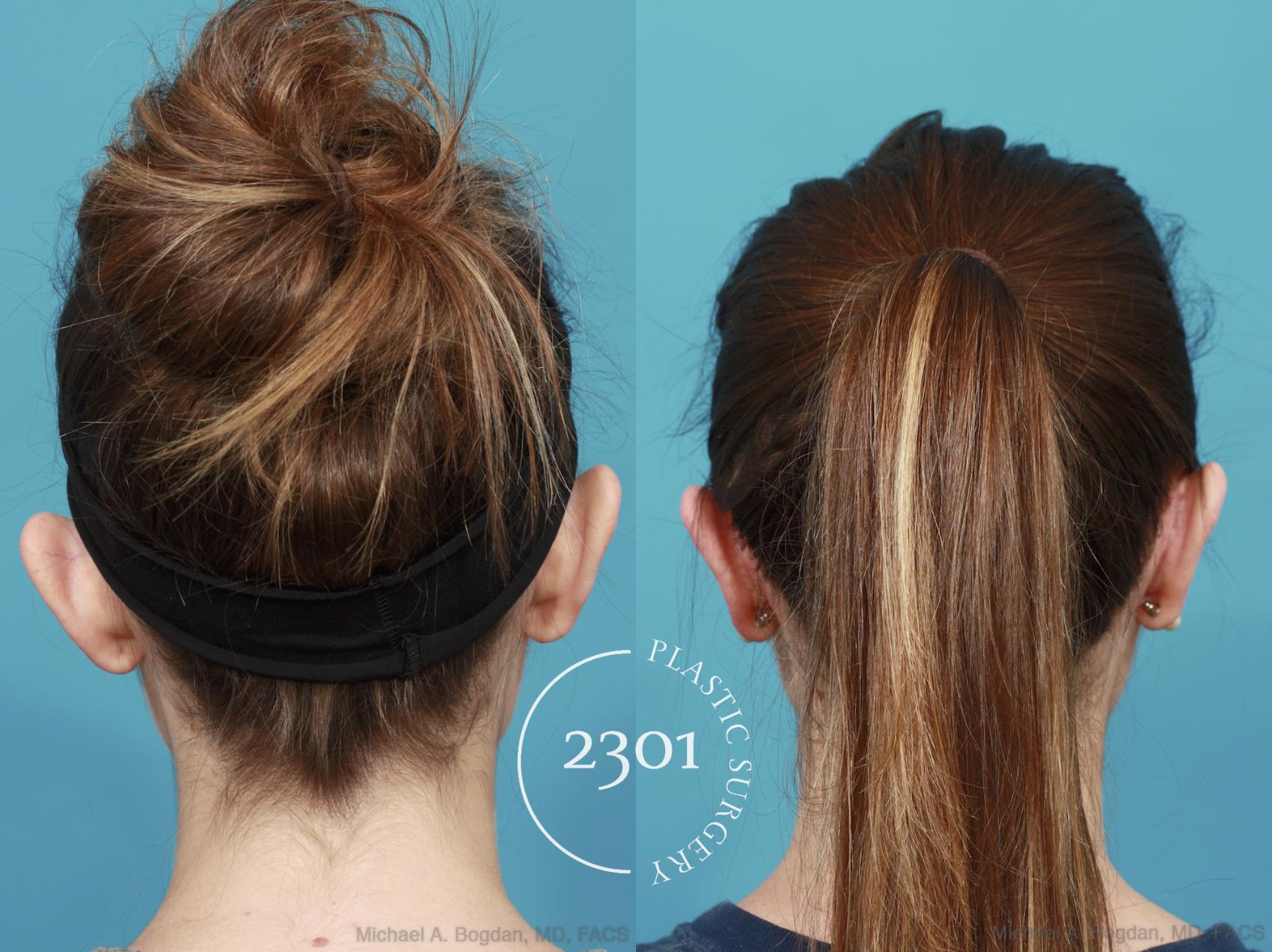 Before & After Otoplasty Case 546 View #4 View in Fort Worth, Plano, & Frisco, Texas