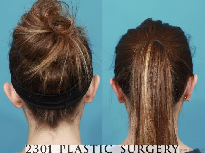 Before & After Otoplasty Case 546 View #4 View in Fort Worth & Frisco, Texas