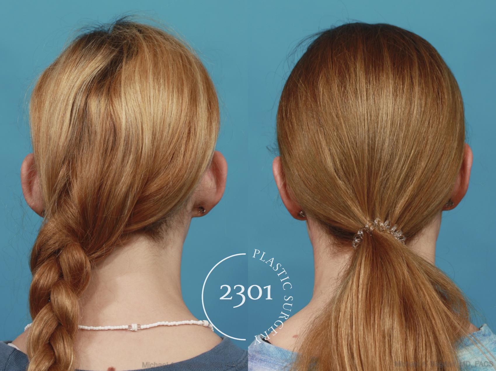 Before & After Otoplasty Case 637 Back View in Fort Worth, Plano, & Frisco, Texas