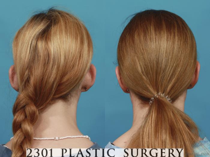 Before & After Otoplasty Case 637 Back View in Fort Worth & Frisco, Texas