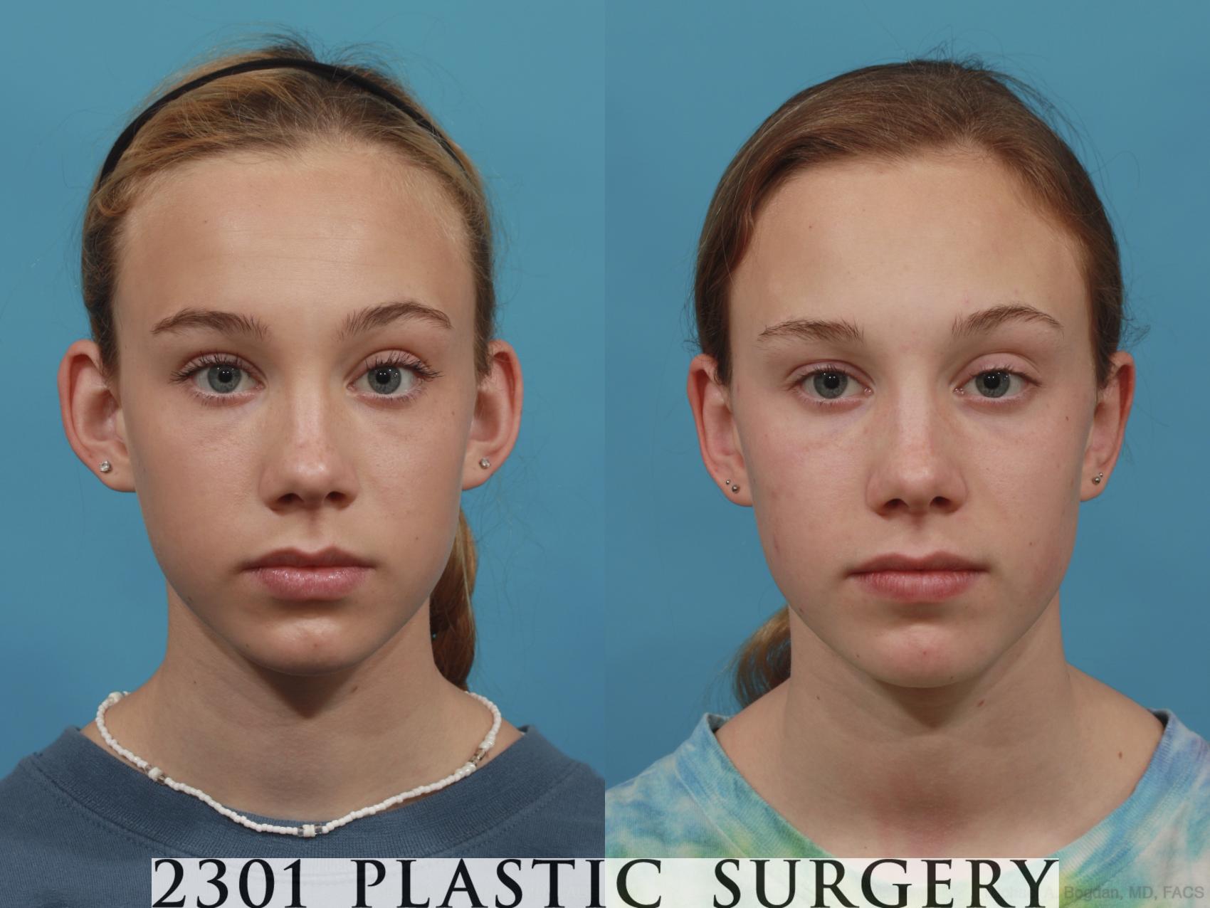 Before & After Otoplasty Case 637 Front View in Fort Worth & Frisco, Texas