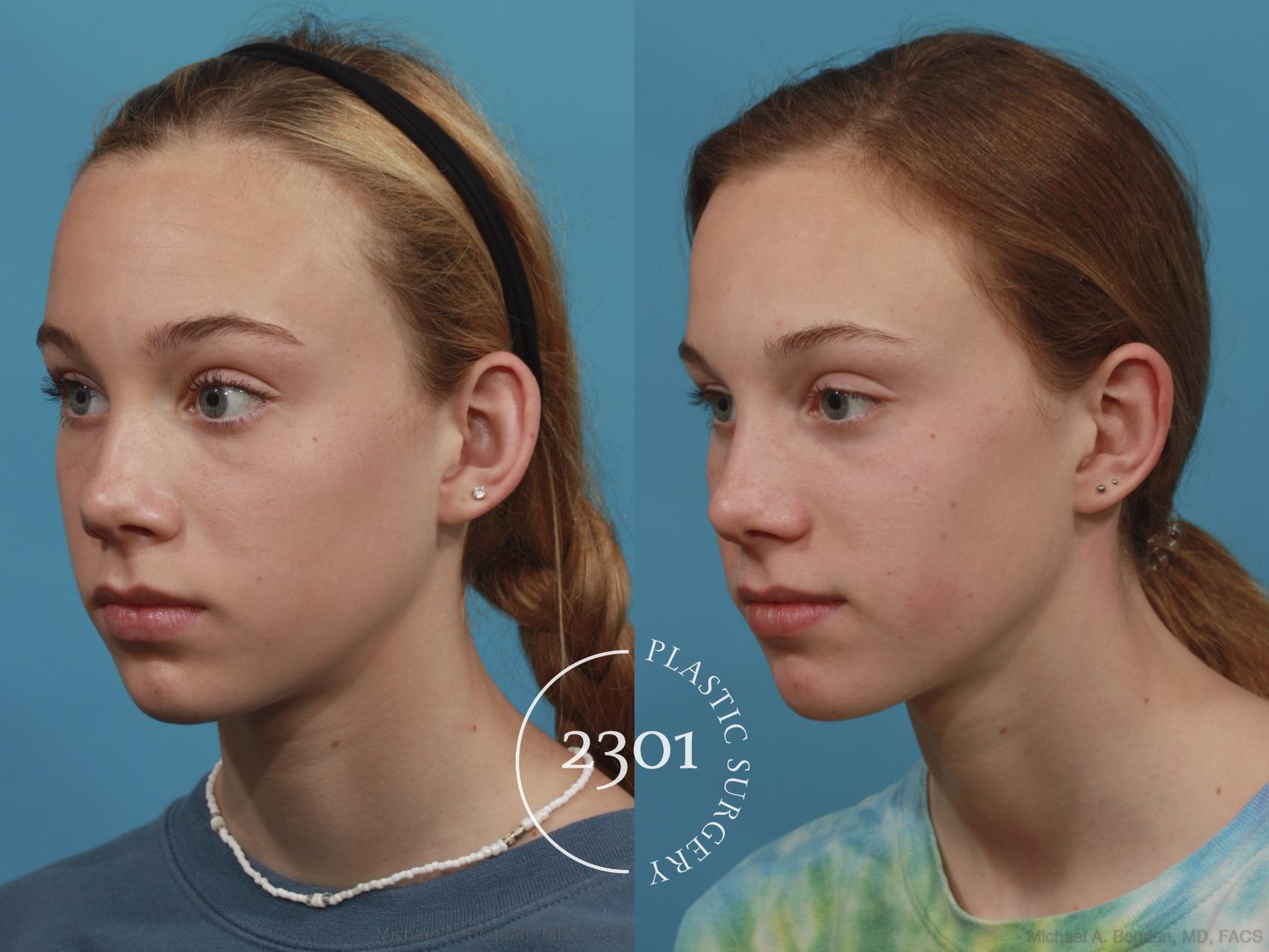Before & After Otoplasty Case 637 Left Oblique View in Fort Worth, Plano, & Frisco, Texas