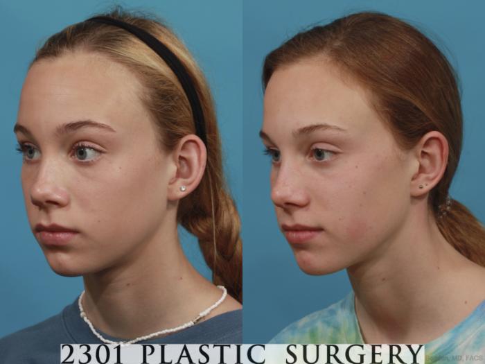 Before & After Otoplasty Case 637 Left Oblique View in Fort Worth & Frisco, Texas