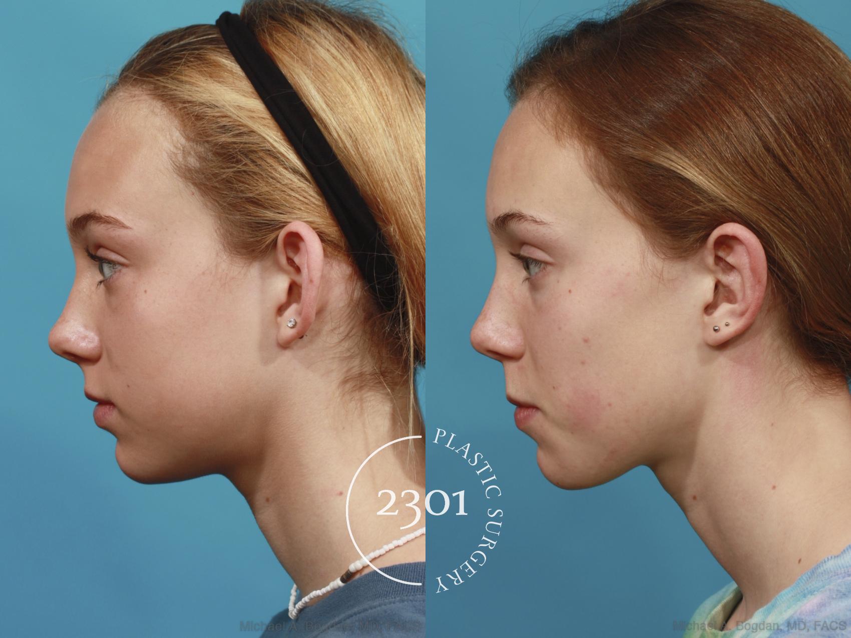 Before & After Otoplasty Case 637 Left Side View in Fort Worth, Plano, & Frisco, Texas