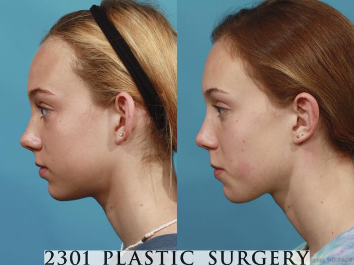 Before & After Otoplasty Case 637 Left Side View in Fort Worth & Frisco, Texas