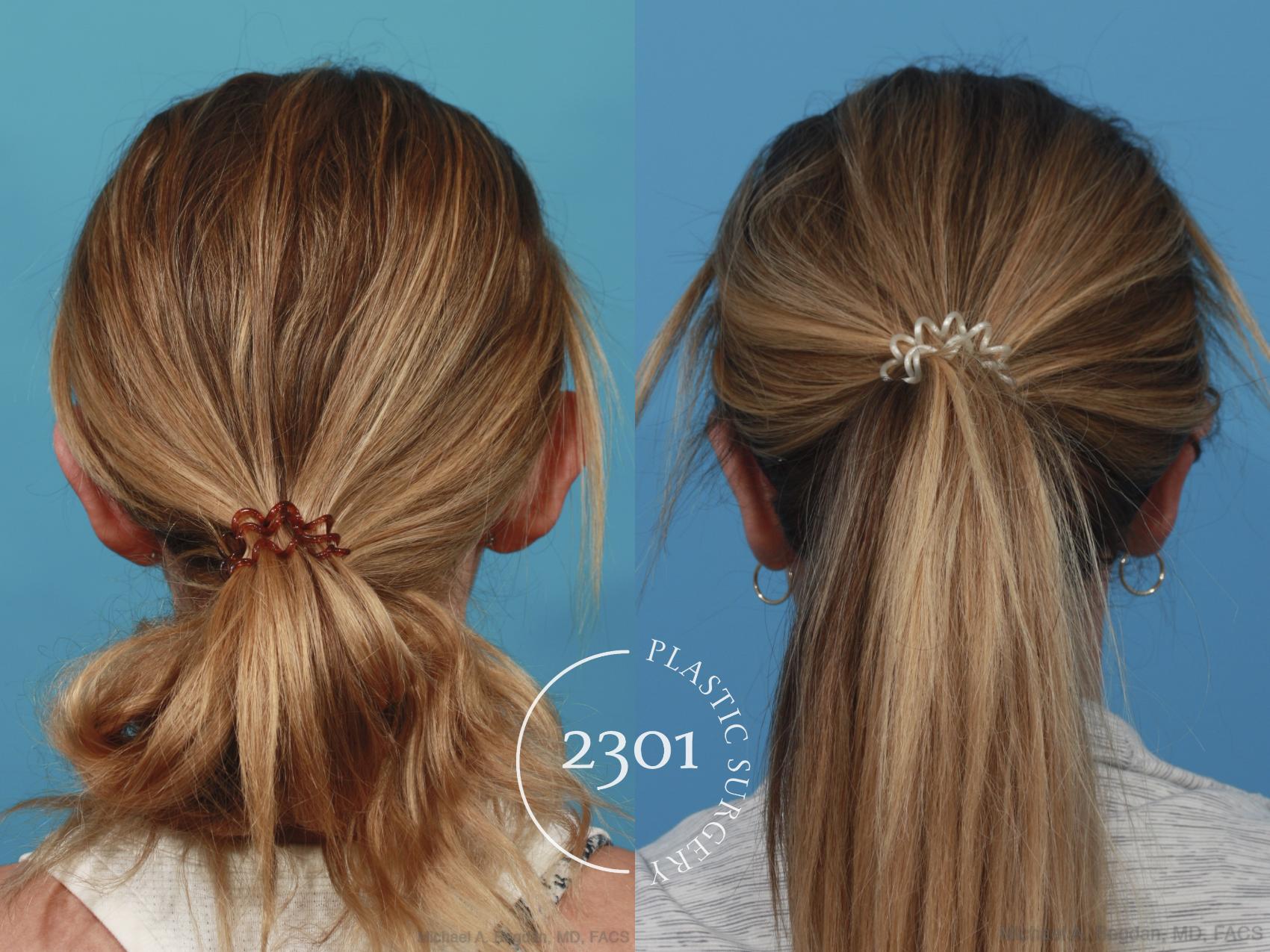 Before & After Otoplasty Case 638 Back View in Fort Worth, Plano, & Frisco, Texas