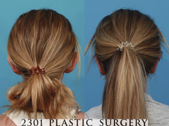 Before & After Otoplasty Case 638 Back View in Fort Worth & Frisco, Texas