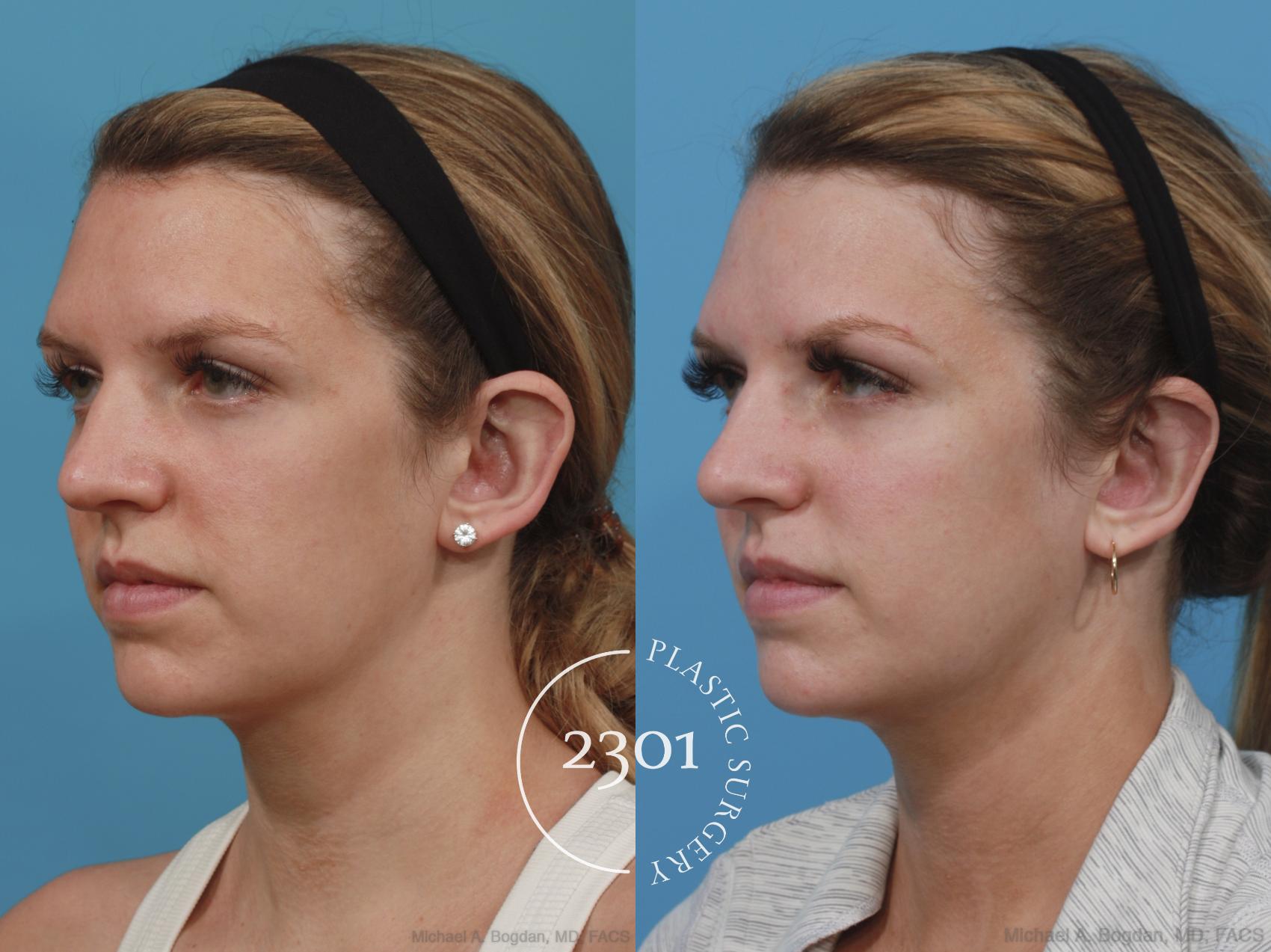 Before & After Otoplasty Case 638 Left Oblique View in Fort Worth, Plano, & Frisco, Texas