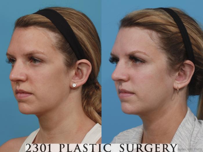 Before & After Otoplasty Case 638 Left Oblique View in Fort Worth & Frisco, Texas