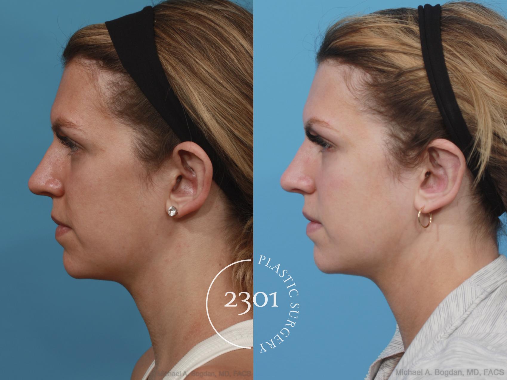 Before & After Otoplasty Case 638 Left Side View in Fort Worth, Plano, & Frisco, Texas