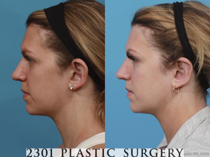 Before & After Otoplasty Case 638 Left Side View in Fort Worth & Frisco, Texas