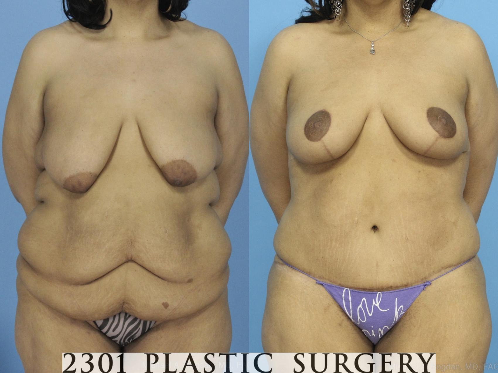 Before & After Post-Bariatric Plastic Surgery Case 373 View #1 View in Fort Worth & Frisco, Texas