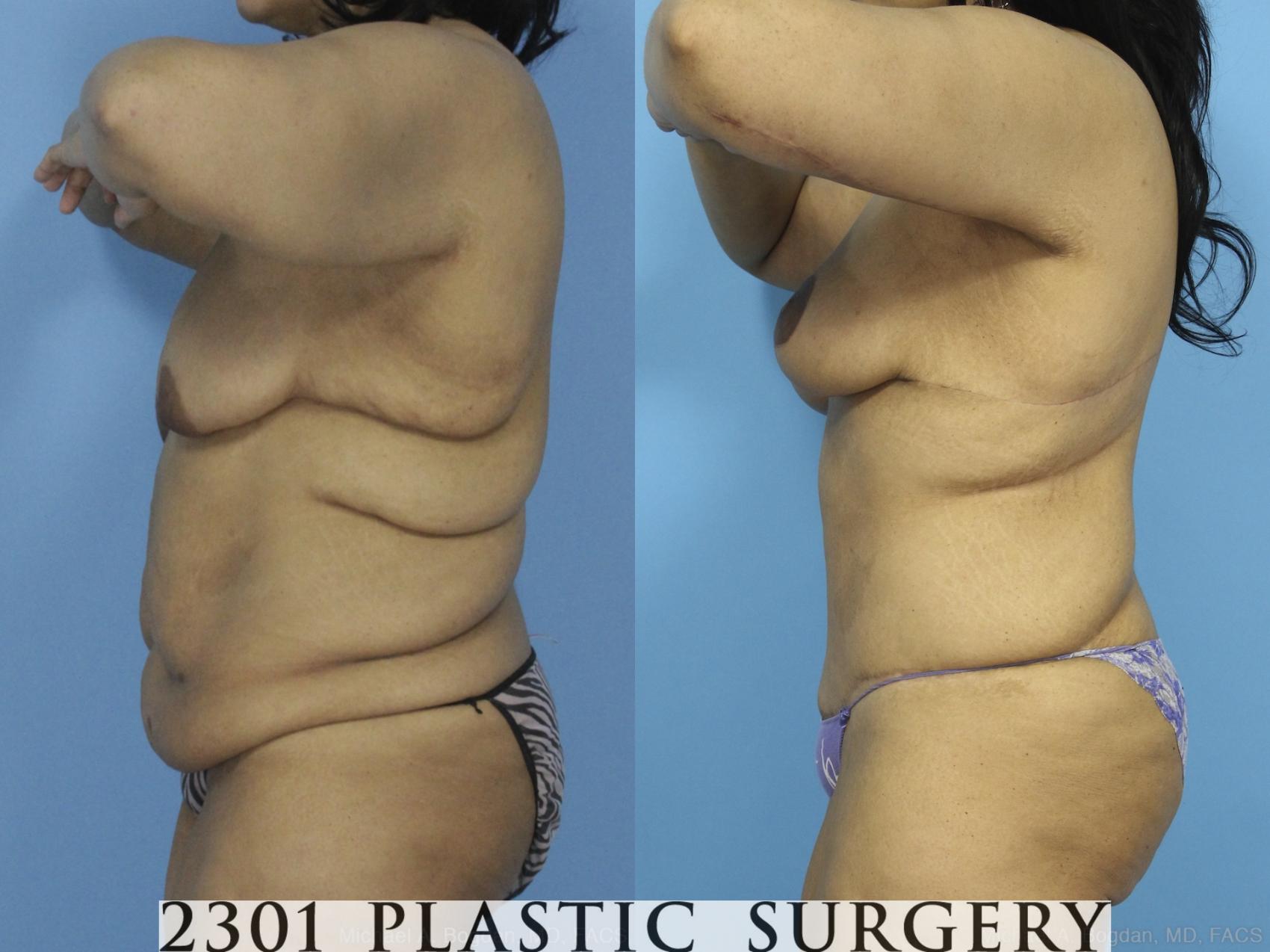 Before & After Post-Bariatric Plastic Surgery Case 373 View #2 View in Fort Worth & Frisco, Texas