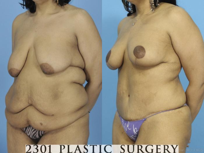 Before & After Bra Line Skin Excision Case 373 View #3 View in Fort Worth, Plano, & Frisco, Texas