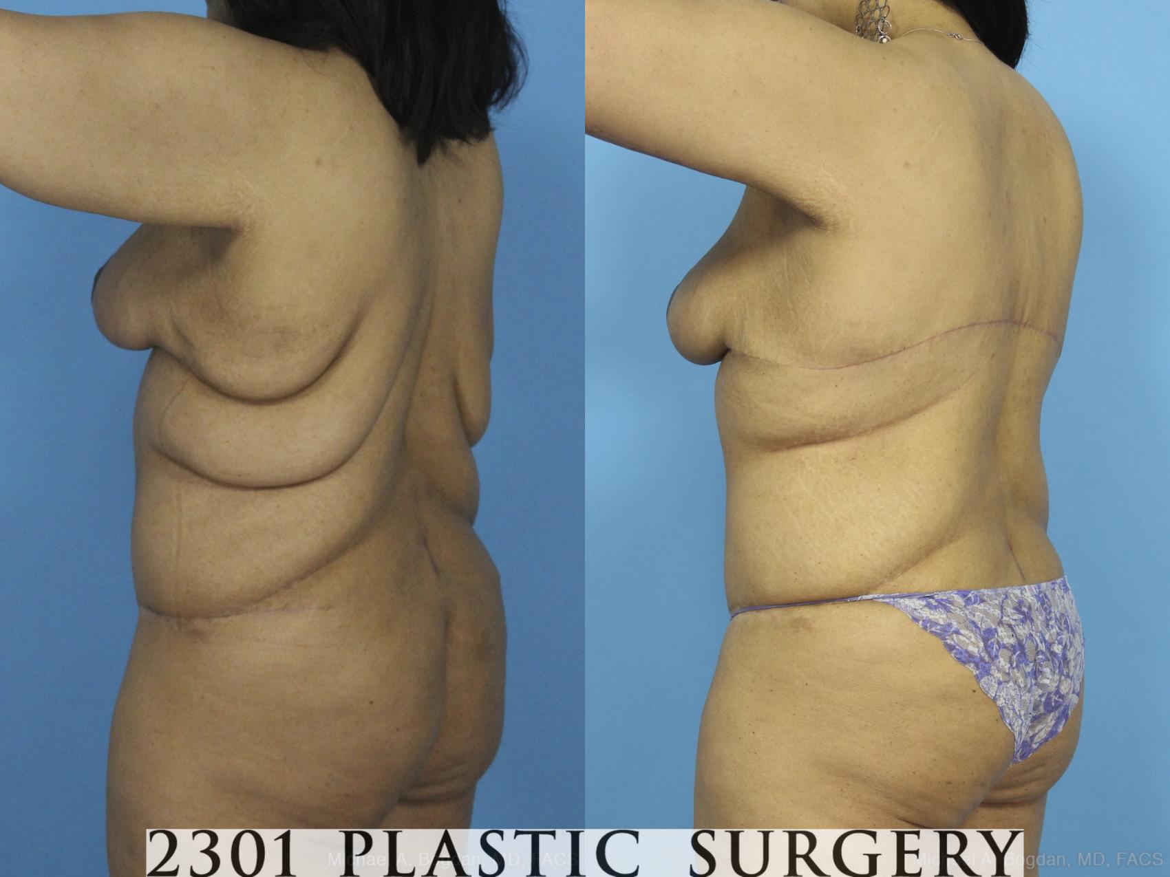 Before & After Post-Bariatric Plastic Surgery Case 373 View #4 View in Fort Worth & Frisco, Texas