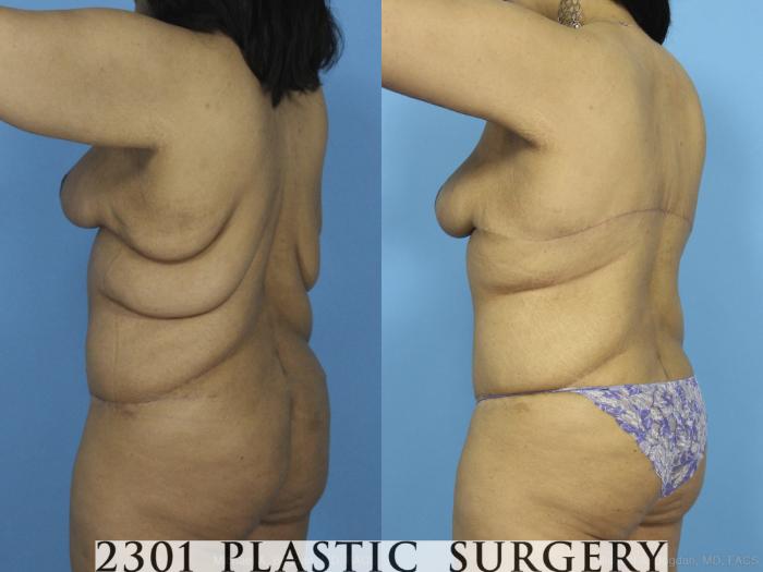 Before & After Post-Bariatric Plastic Surgery Case 373 View #4 View in Fort Worth, Plano, & Frisco, Texas