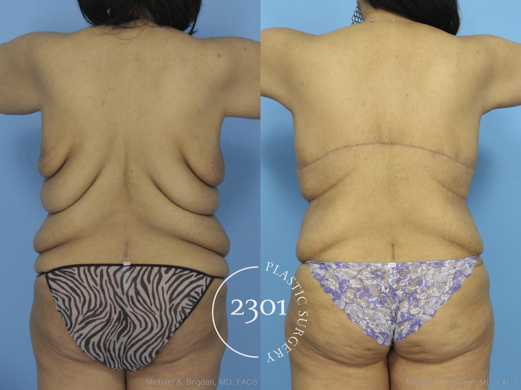 Before & After Bra Line Skin Excision Case 373 View #5 View in Fort Worth, Plano, & Frisco, Texas