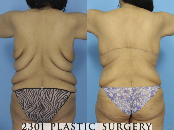 Before & After Breast Lift (Mastopexy) Case 373 View #5 View in Fort Worth, Plano, & Frisco, Texas