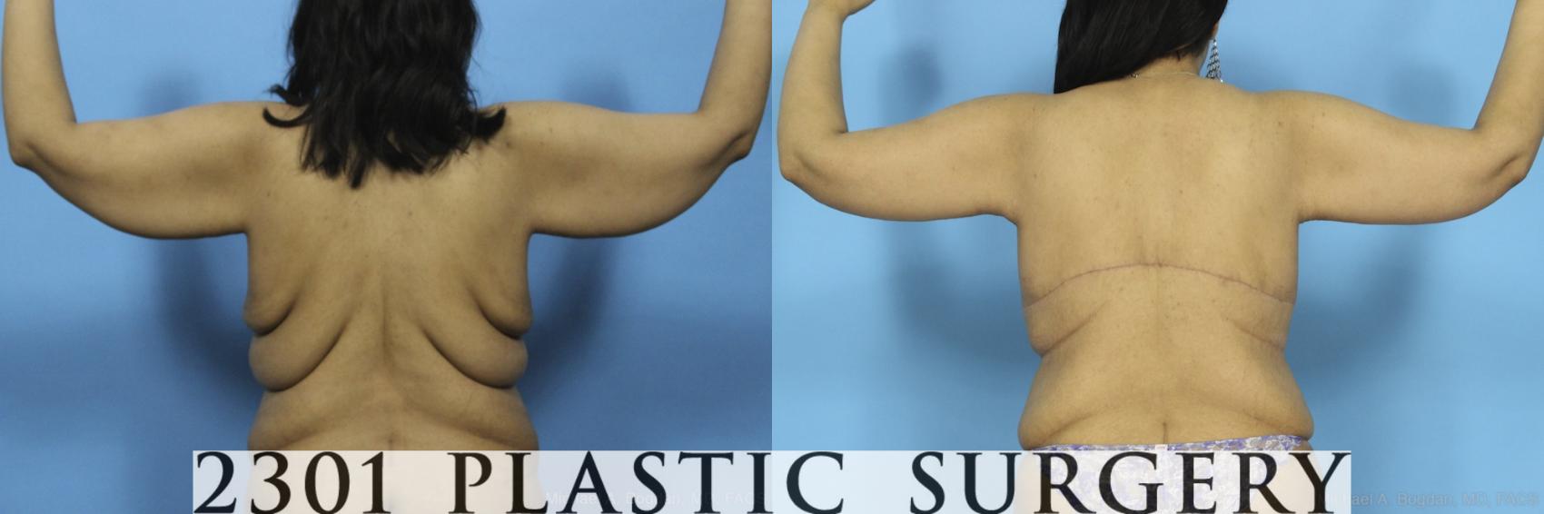 Before & After Post-Bariatric Plastic Surgery Case 373 View #6 View in Fort Worth & Frisco, Texas