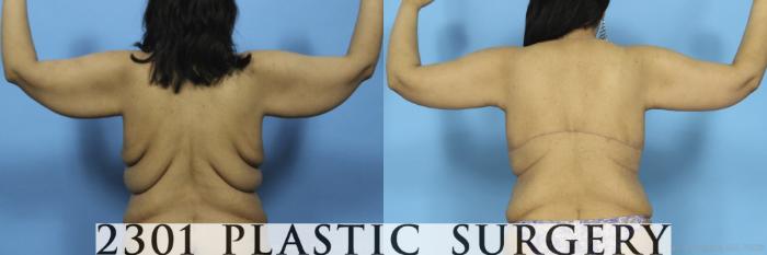 Before & After Post-Bariatric Plastic Surgery Case 373 View #6 View in Fort Worth, Plano, & Frisco, Texas